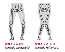 ortezy - sposóby korekcji kończyny